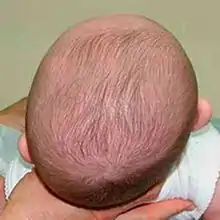 Right posterior plagiocephaly