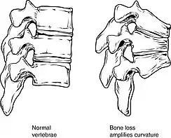 Collapse of vertebra on the right, normal on the left