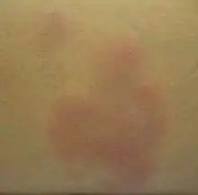 A single lesion of erythema nodosum