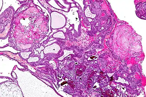 Micrograph showing the characteristic features of an adamantinomatous craniopharyngioma - cystic spaces, calcifications, and "wet" keratin, HPS stain