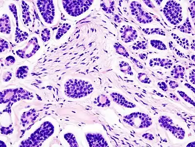 Histopathological image of adenoid cystic carcinoma of the salivary gland infiltrating a nerve (center), H&E stain