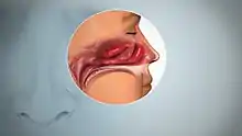 A side view anatomical drawing of the nasal sinuses depicting inflamed mucosa