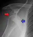 Anterior dislocation of the right shoulder. AP X ray