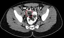 Epiploic appendagitis in computed tomography.