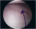 Bankart lesion seen at arthroscopy