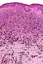 Micrograph of a blue nevus showing the characteristic pigmented melanocytes between bundles of collagen. H&E stain