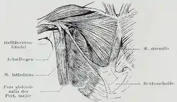 Sternalis muscle visible in an individual who also has an accessory abdominal pectoralis major, and an axillary arch of the latissimus dorsi.