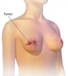 As seen on the image above the  breast is already affected with cancer