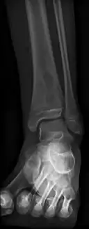 Periostial reaction along the medial cortex indicates an aggressive lesion.  Neoplasm such as Ewing sarcoma and osteomyelitis could both have this plain radiographic appearance. Staphylococcus was recovered at surgery.