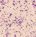 Peripheral blood stain of chronic myelogenous leukemia in accelerated phase (blast crisis)