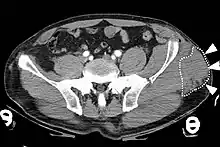 Image is of a computed tomography (CT) image of a Morel-Lavallee lesion.