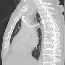 CT scan showing a port whose tip goes into the azygos vein.