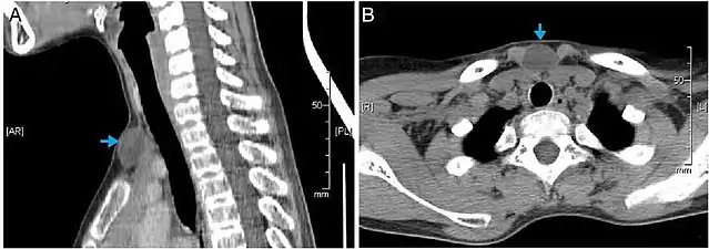 CT scan, showing a homogenous hypodense volume (unspecific cyst-like)