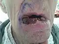 Large squamous-cell carcinoma (SCC) of lower lip