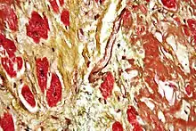 Movat's stain showing amyloid (brown) and fibrosis (yellow) of the heart.