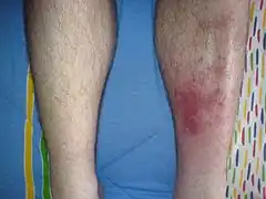 Redness and mild swelling of an adult leg