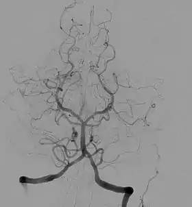 Cerebral angiogram showing an anterior/posterior projection of the vertebrobasilar and posterior cerebral circulation, the posterior aspect of the circle of Willis, and one of its feeding vessels