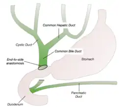 End-to-Side Anastomosis