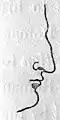 Rhinoplasty: Nasal Class I. The Roman nose. (Nasology Eden Warwick, 1848)