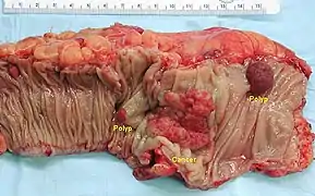 Gross appearance of a colectomy specimen containing two colorectal polyps and one invasive colorectal carcinoma