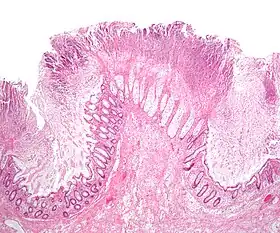 Micrograph of pseudomembranous colitis