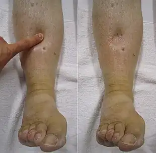 Image of a leg with "pitting" edema, a transient depression of the skin after pressure is applied. When this happens on one side, it increases the likelihood of DVT.