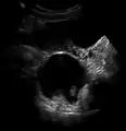 A complex cyst due to a dermoid as seen on ultrasound