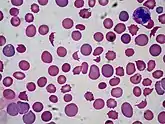  This microscopic image of peripheral blood smear shows schitocytes and also known as helmet cells which is seen in microangiopathic hemolytic anemia (MAHA) which are result of cutting of rbc in small vessel. MAHA seen in throbotic throbocytopenic purpura (TTP), metallic heart valve and Hemolytic uremic syndrome