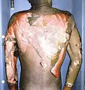 Autopsy photograph of Rainey’s back.