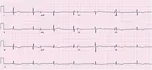 An ECG showing sinus bradycardia at 43 bpm. The image is made up of a red grid on a white background. A black line traces the patients heart beat.