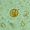 Immature E. histolytica/E. dispar cyst in a concentrated wet mount stained with iodine. This early cyst has only one nucleus and a glycogen mass is visible (brown stain).