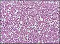 Micrograph of fatty liver showing lipid steatosis. H&E stain.