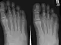 X-ray of foot.