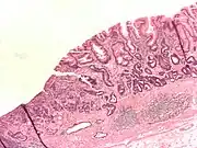 Adenocarcinoma of the stomach and intestinal metaplasia. H&E stain.