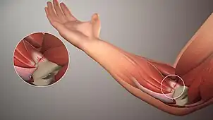 A 3D medical animation still shot illustrating Golfer's elbow