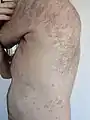 The rash of guttate psoriasis on a 66-year-old male