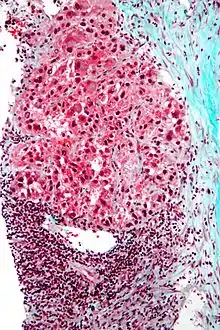 Mallory bodies in hepatocellular carcinoma. Trichrome stain.