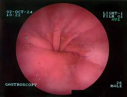 Upper GI endoscopy depicting hiatal hernia