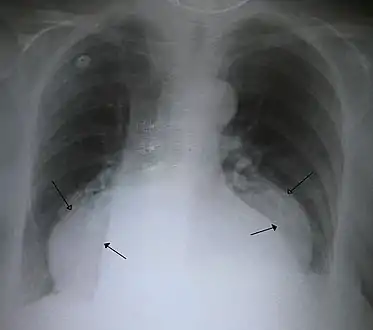 A large hiatal hernia on chest X-ray marked by open arrows in contrast to the heart borders marked by closed arrows