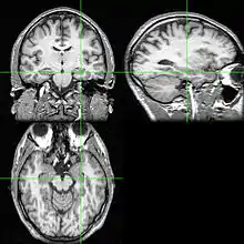 MRI scan of brain