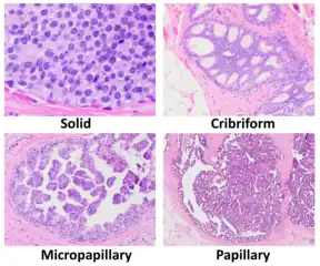 Histopathologic architectural patterns of DCIS.