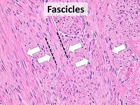 Fascicular: Generally the same cell type throughout, but some form band-like groups that are aligned in the same direction.