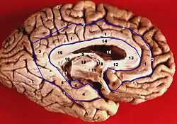 Inferior Medial View of a Dissected Brain