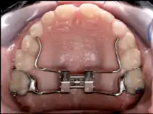 Palatal expander