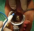 Incision at intersphincteric groove