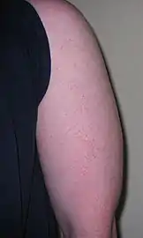 Keratosis pilaris on back of upper arm