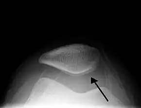 Skyline view of the patella demonstrating a large joint effusion as marked by the arrow.