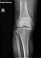 Knee X-ray (weight bearing)