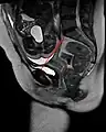 Conjugata vera as measured on sagittal MRI