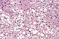 Histological section of a mouse's liver showing severe steatosis. The clear vacuoles contained lipid in life; however, histological fixation caused it to be dissolved and hence only empty/clear spaces are seen.